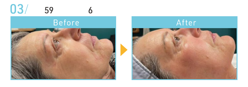 資料記載なし(写真参照)のBeforeとAfterの施術例