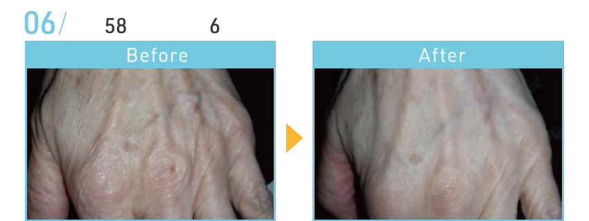 資料記載なし(写真参照)のBeforeとAfterの施術例